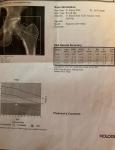 Увеличение дозировки лекарства при ревматоидном артрите и остеопорозе фото 2