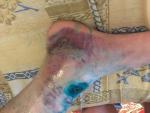 Травма связок голеностопного сустава фото 2