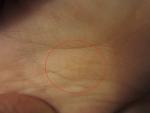 Бесцветная сыпь на пальцах у ребенка фото 2