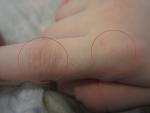 Бесцветная сыпь на пальцах у ребенка фото 3