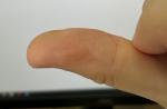 Специфические высыпания на пальцах рук фото 3