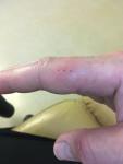 Рана на руке от гвоздя, вероятность заражения столбняком фото 1