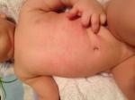 Мелкая красная сыпь у малыша в 8 месяцев фото 2