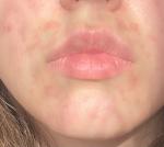 Периоральный дерматит или красные пятна вокруг рта фото 1