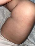 Аллергия у ребенка в 1,5 года три недели не проходит фото 3