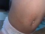 Аллергия у ребенка в 1,5 года три недели не проходит фото 2