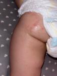 Аллергия у ребенка в 1,5 года три недели не проходит фото 1