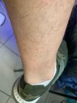 Сыпь странного происхождения на ногах и руке фото 3