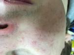 Пятна на лице похожие на прыщи или аллергия фото 2