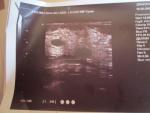 При маммографии обнаружены микрокальцинаты и какая то тень фото 3