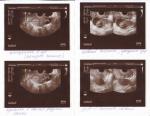 Кисты обоих яичников, эндометриоз и миомы фото 4