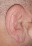 Шелушение, трещины в ушах, в чем причина? фото 2