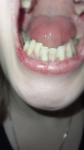 Зубы нижние фото 1