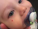 Красное пятно под глазом у ребенка 1,5 года фото 1