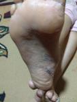Трещины на ноге фото 2