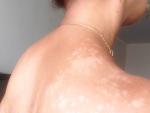 Светлые пятна на коже плеч шеи спины фото 2