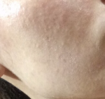 Сыпь на лице из-за стресса фото 2