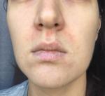 Сыпь на лице краснота и периодически пузырьки фото 2