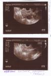 Кисты обоих яичников, эндометриоз и миомы фото 3