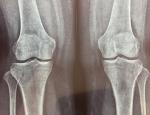 Стреляющие боли в колене, диагноз артрит фото 1