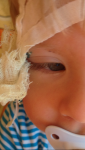 У ребёнка После наложения швов на бровь пявился отек фото 2