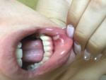 Стоматит и шишки под языком при беременности фото 2