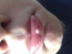 Болячка белого цвета на губе, снаружи фото 2