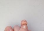 Неровный рост ногтя, боль и шелушение под ним фото 1
