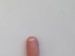 Неровный рост ногтя, боль и шелушение под ним фото 2