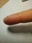 Отслоение ногтя и водянистые точки около ногтей фото 5