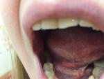 Воспаление под языком фото 1