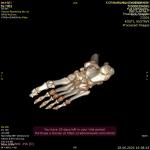 Перелом пяточной кости с смещением и поздний гипс фото 3