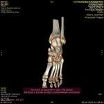 Перелом пяточной кости с смещением и поздний гипс фото 2