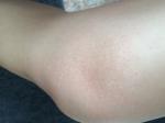 Мелкая сыпь на коленях при беременности фото 3