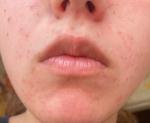 Периоральный дерматит или красные пятна вокруг рта фото 4