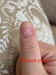 Деформация ногтей фото 4
