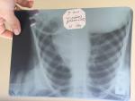 Плановый рентген снимок ребенка после пневмонии фото 1
