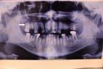 Удаление здорового зуба под протез фото 1