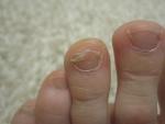 Как лечить грибок на ногтях при грудном вскармливании фото 2