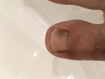 Темные пятна на ногтях обоих больших пальцев ног фото 2