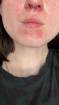 Красные шелушащиеся пятна в области носа и подбородка фото 1