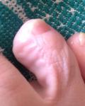 Проблема с подушечкой пальца на ноге фото 2