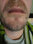 Покраснение, зуд, шелушение на бороде, бровях и голове фото 3