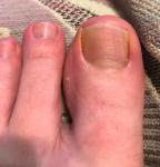 Проблема с ногтями на больших пальцах ног и рук фото 4