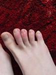 Почервоніння, зуд, припухлість пальцев ніг фото 5