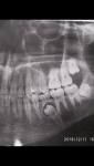 Киста в зубе фото 1