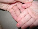 Шелушение и пятна на подушечках пальцев рук фото 1