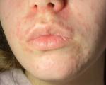 Периоральный дерматит или красные пятна вокруг рта фото 3