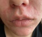 Периоральный дерматит или красные пятна вокруг рта фото 2