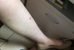 Красная сыпь с гнойничками на ноге фото 2
